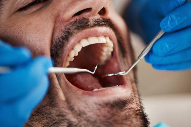 Best Emergency Gum Treatment in Lanse, MI